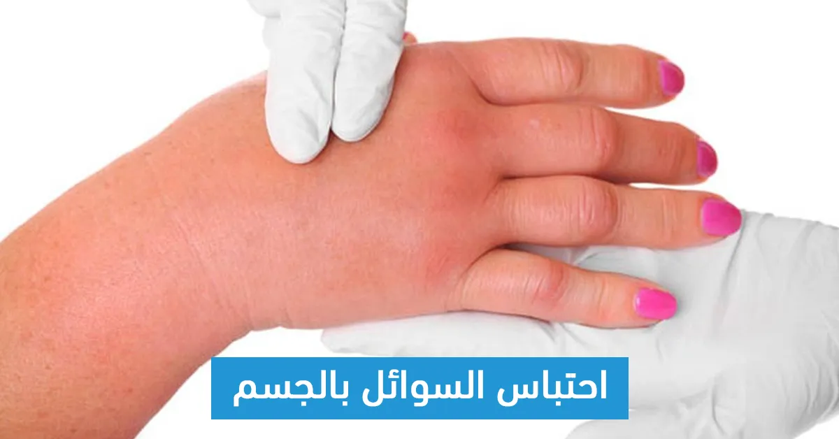 احتباس السوائل بالجسم